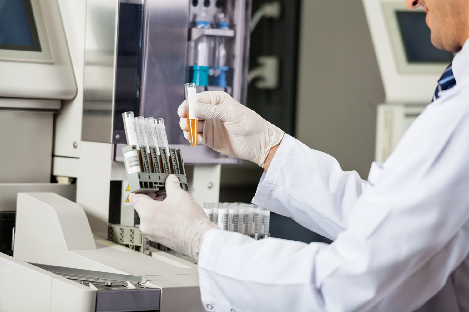 What Are the Different Types of Urine Specimen Collection? - iProcess